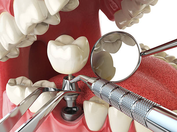 Best Emergency Dental Care for Sports Injuries in Duarte, CA